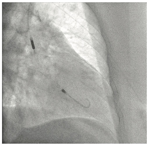 Tai PercAx Impella Figure 8