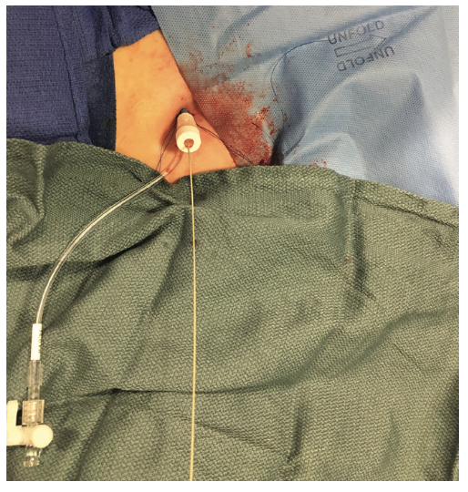 Tai PercAx Impella Figure 9