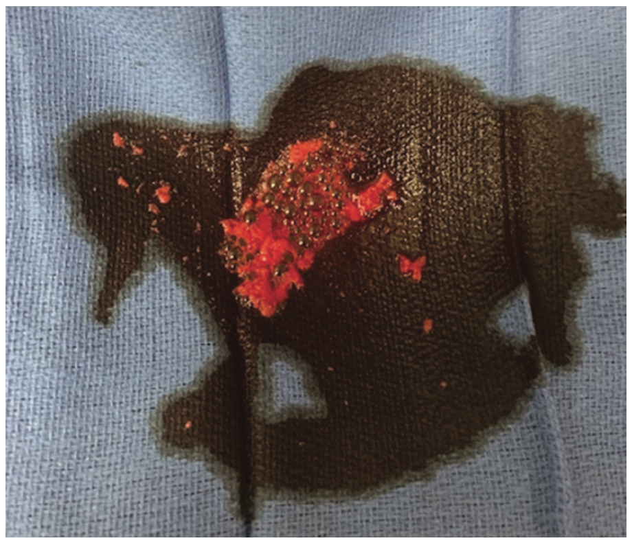 Tai Transcollateral Figure 3