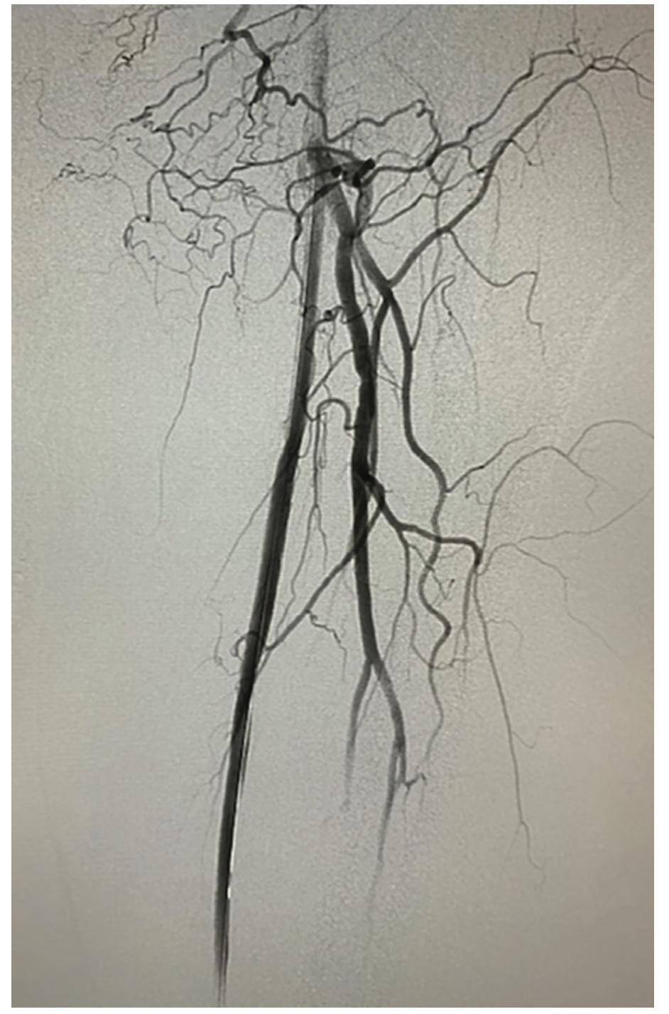 Tai Transcollateral Figure 4