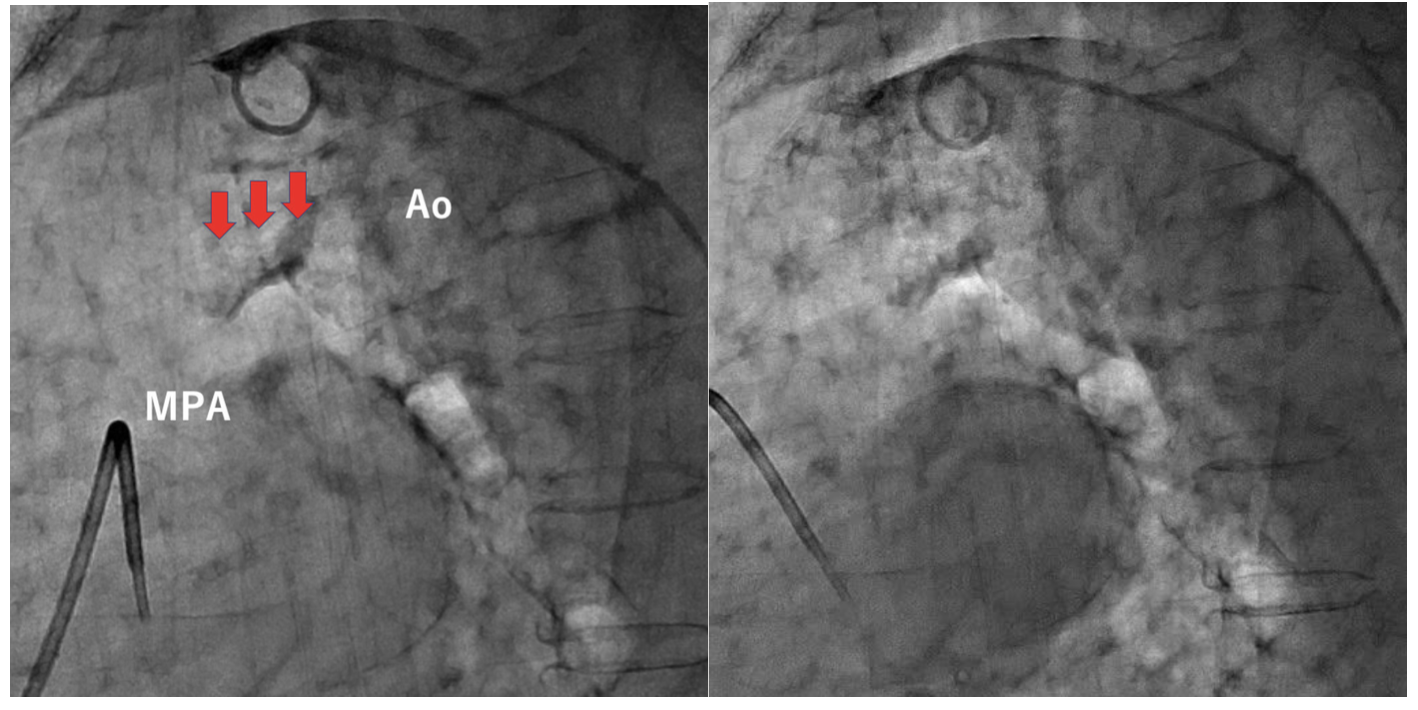 Takafuji Patent Ductus Arteriosus Figure 2