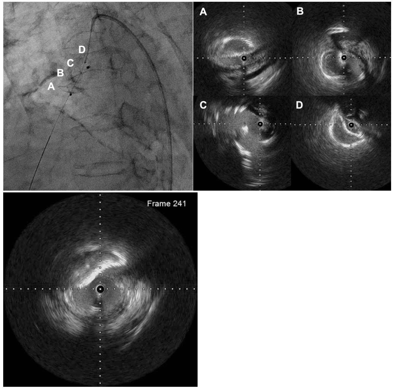 Takafuji Patent Ductus Arteriosus Figure 3