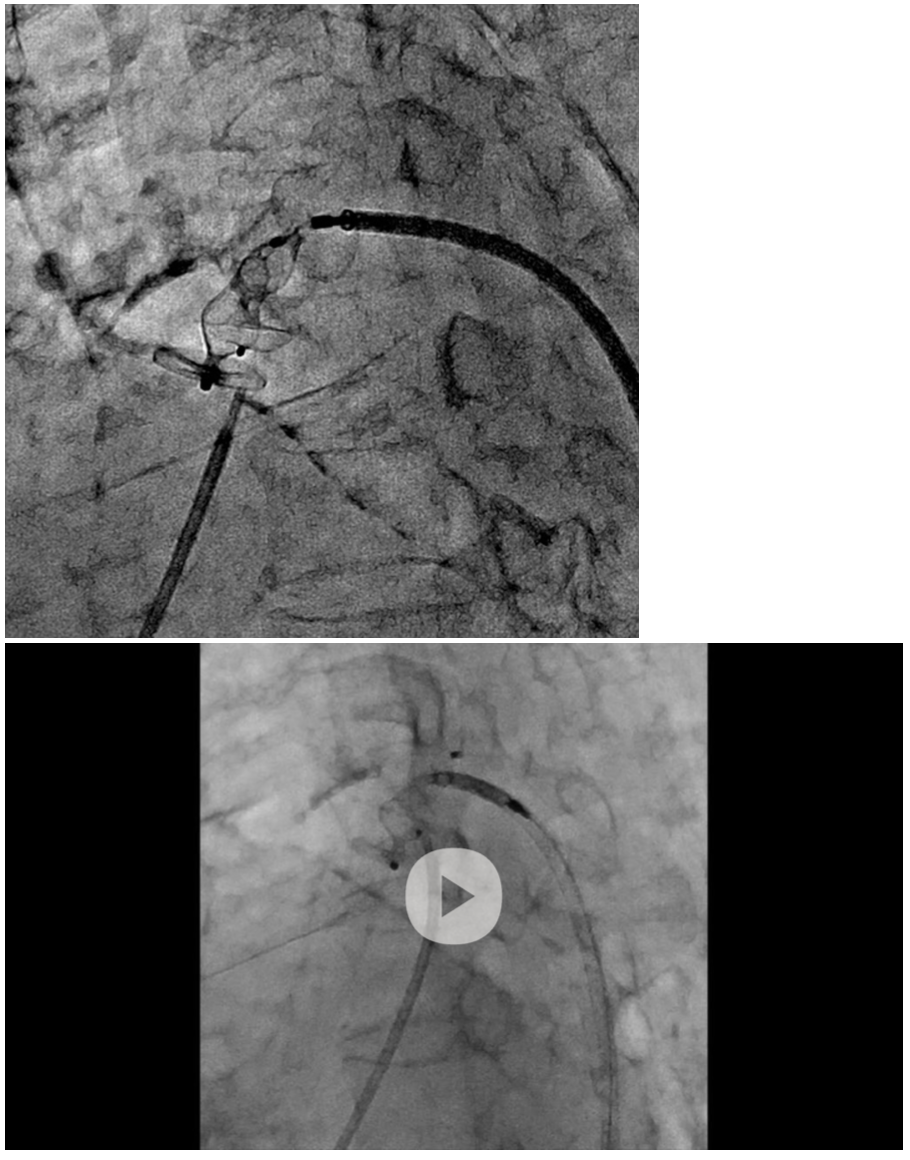 Takafuji Patent Ductus Arteriosus Figure 4