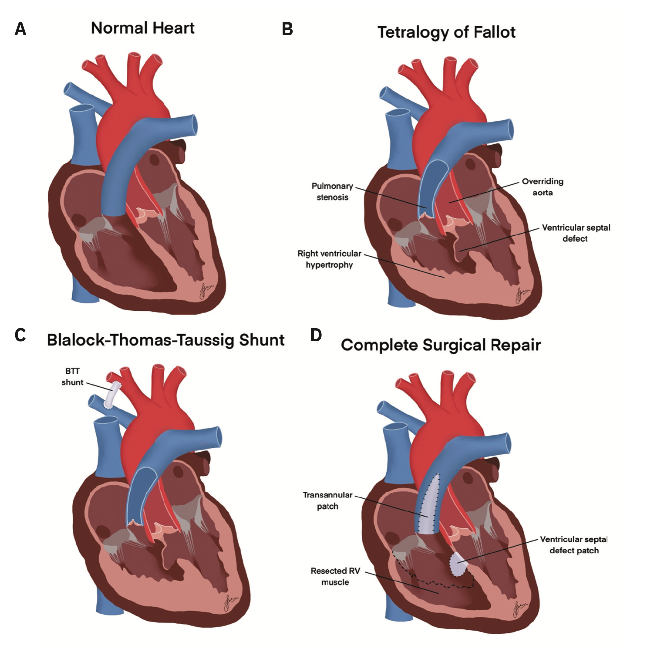 Tale Tetralogy of Fallot Figure 1