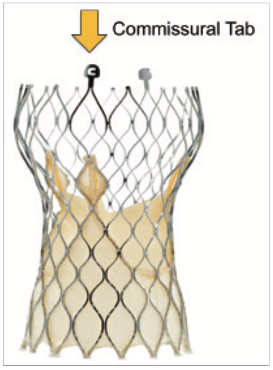 Tang Aortic Valve Figure 1