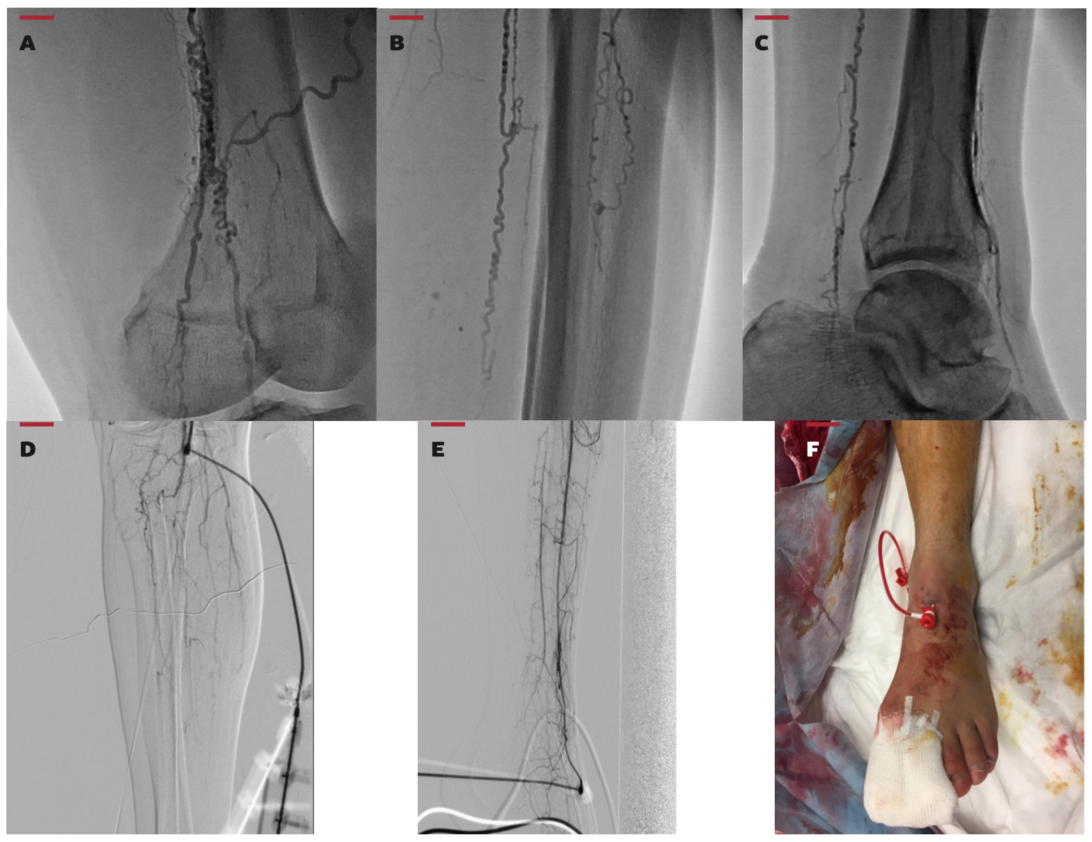 Tatli Buerger’s Disease Figure 1