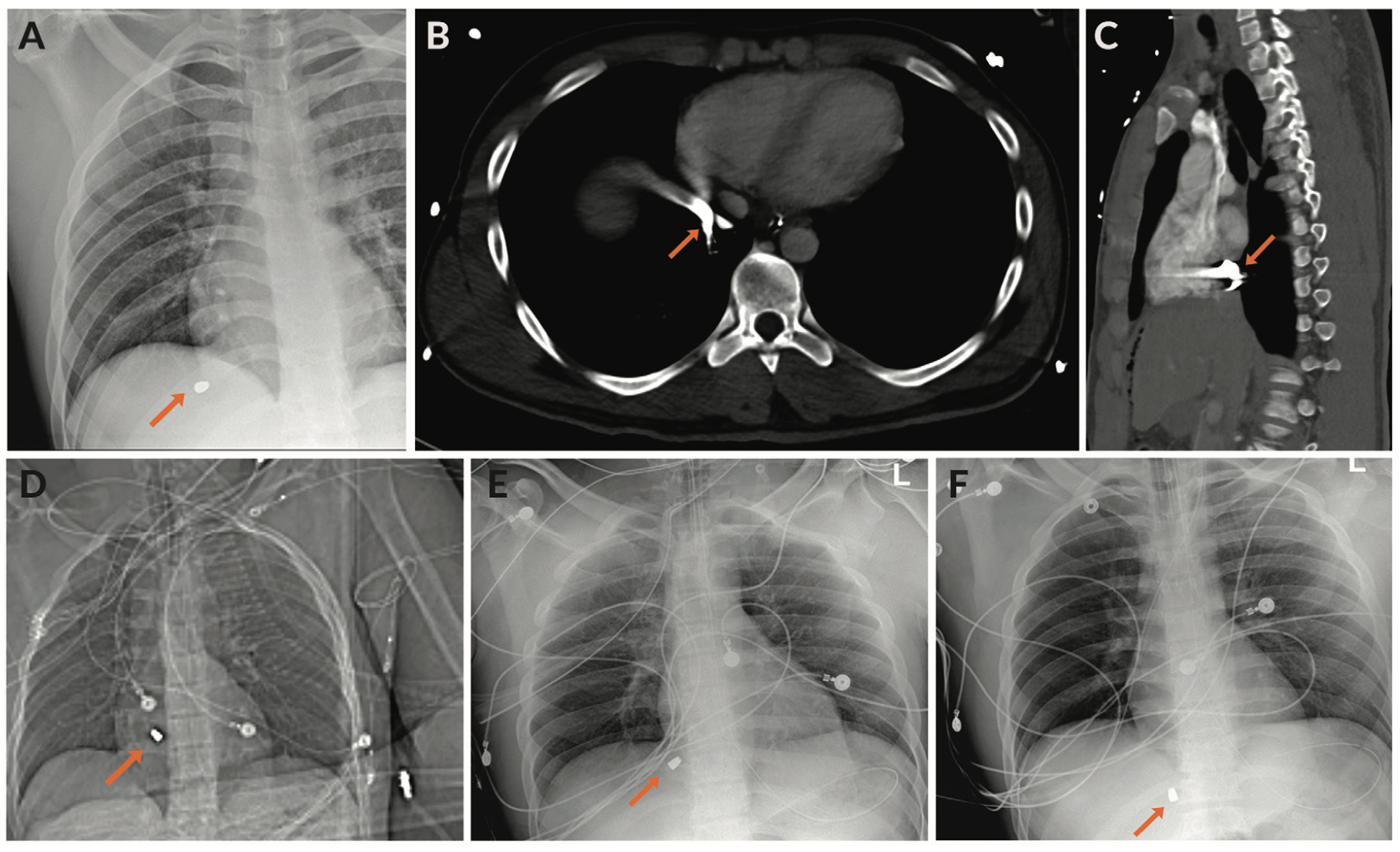 Terrill Central Embolization Figure 2