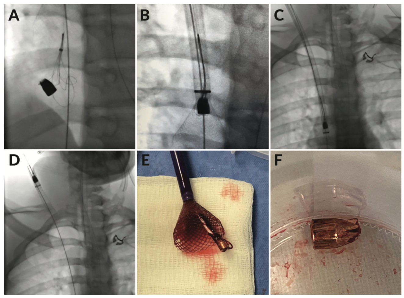 Terrill Central Embolization Figure 3