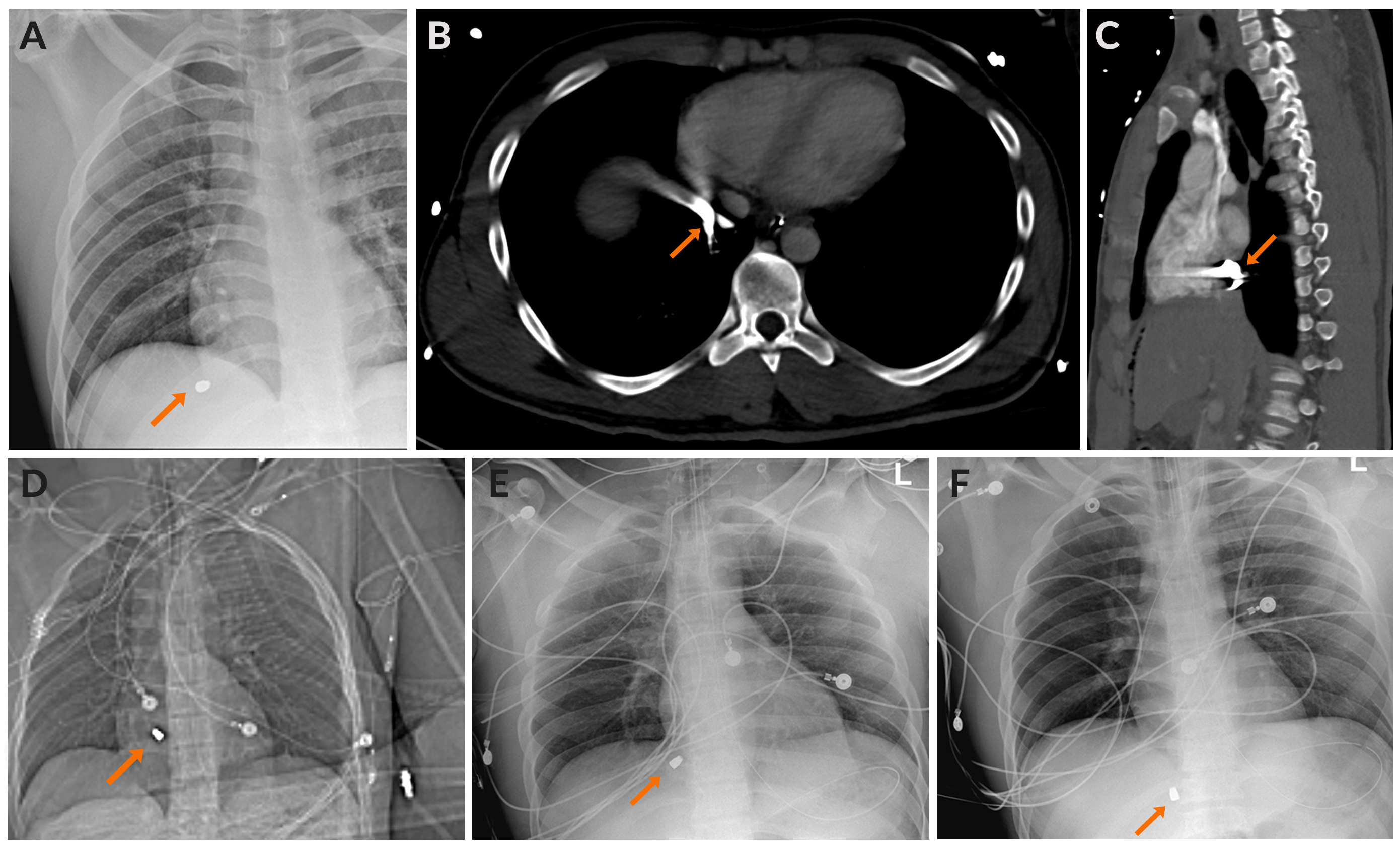 Figure 2. On presentation, a chest radiograph showed a metallic ballistic object projecting over the high right upper quadrant of the abdomen below the right hemidiaphragm (A). Following exploratory laparotomy during which the bullet was not found in the abdomen, computed tomography images suggested an intravascular location at the inferior cavoatrial junction on axial (B), sagittal (C), and scout (D) images. Preprocedural portable chest radiographs taken hours apart also suggested fragment mobility (E-F).