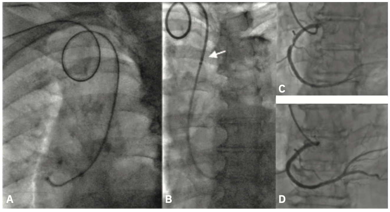 Terumo Rufus Peripheral Procedures Figure 1