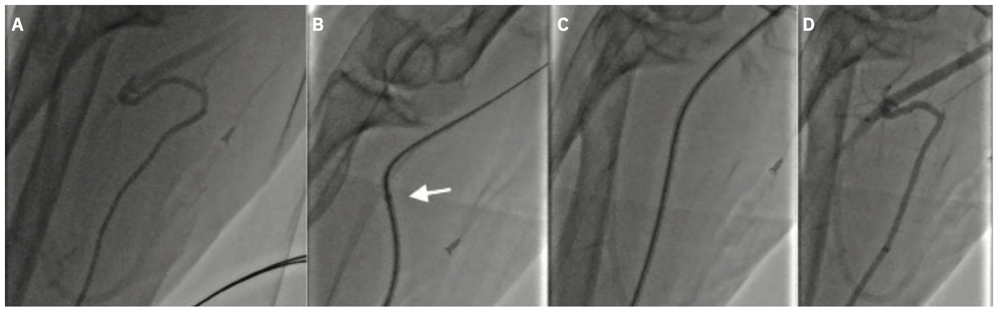 Terumo Rufus Peripheral Procedures Figure 2