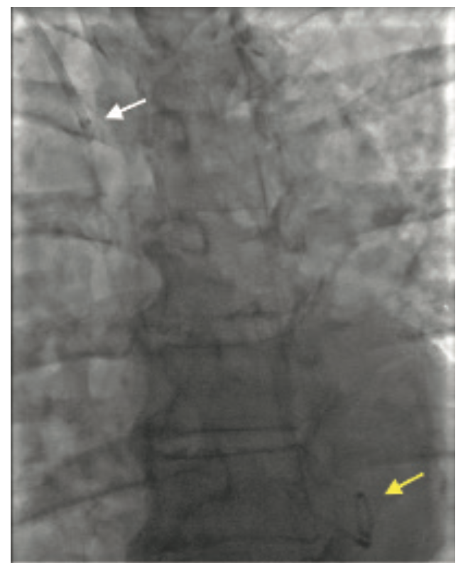 Terumo Rufus Peripheral Procedures Figure 3