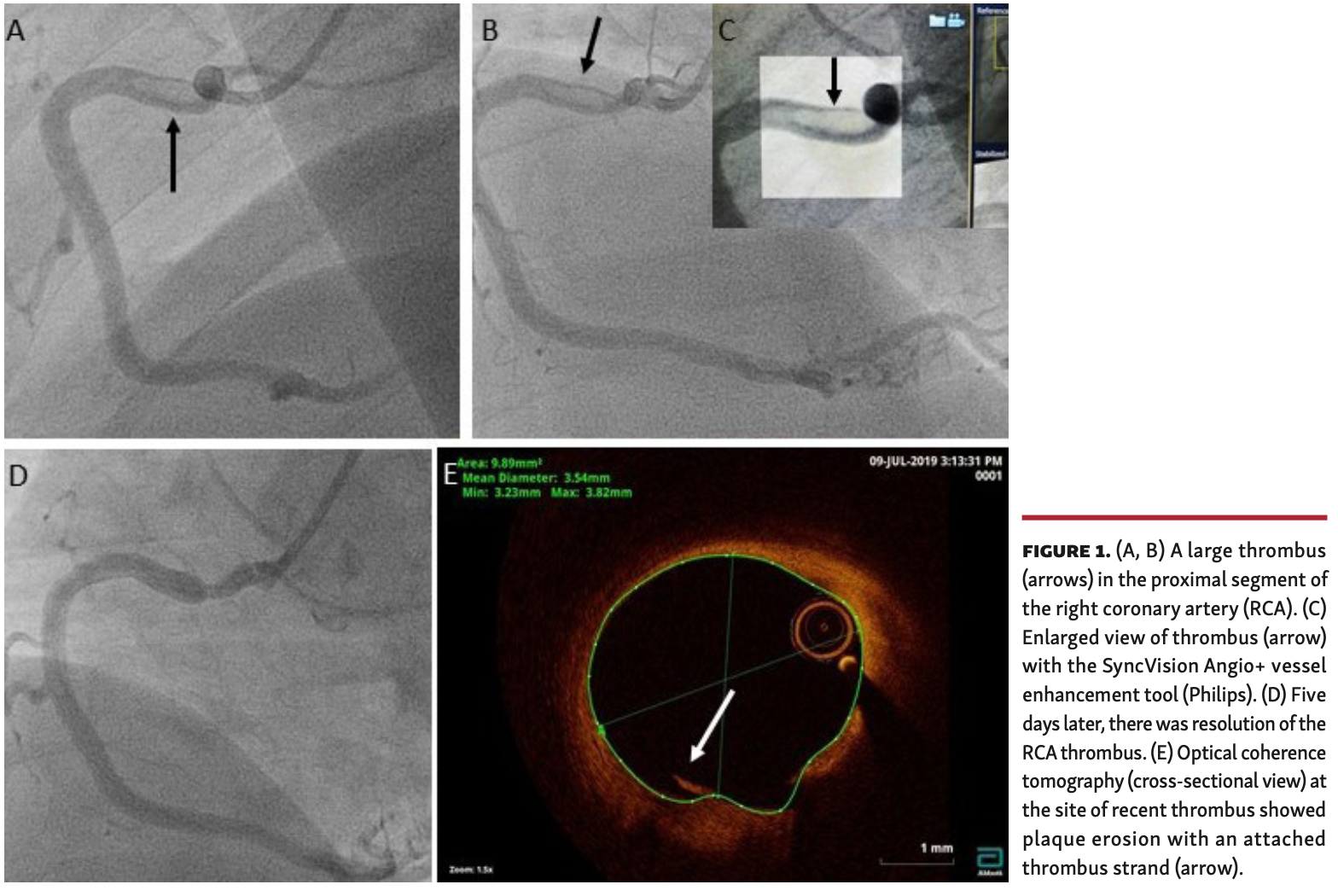 Theodoropoulos primary PCI Figure 1