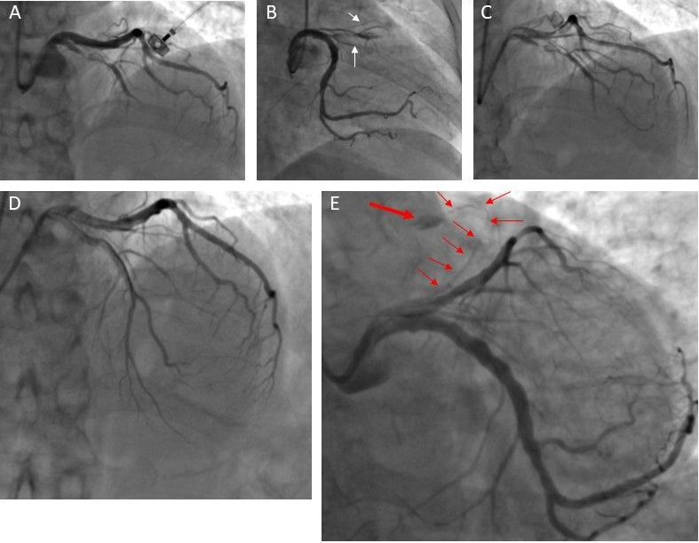Figure 1. Sub-total occlusion of the proximal LAD