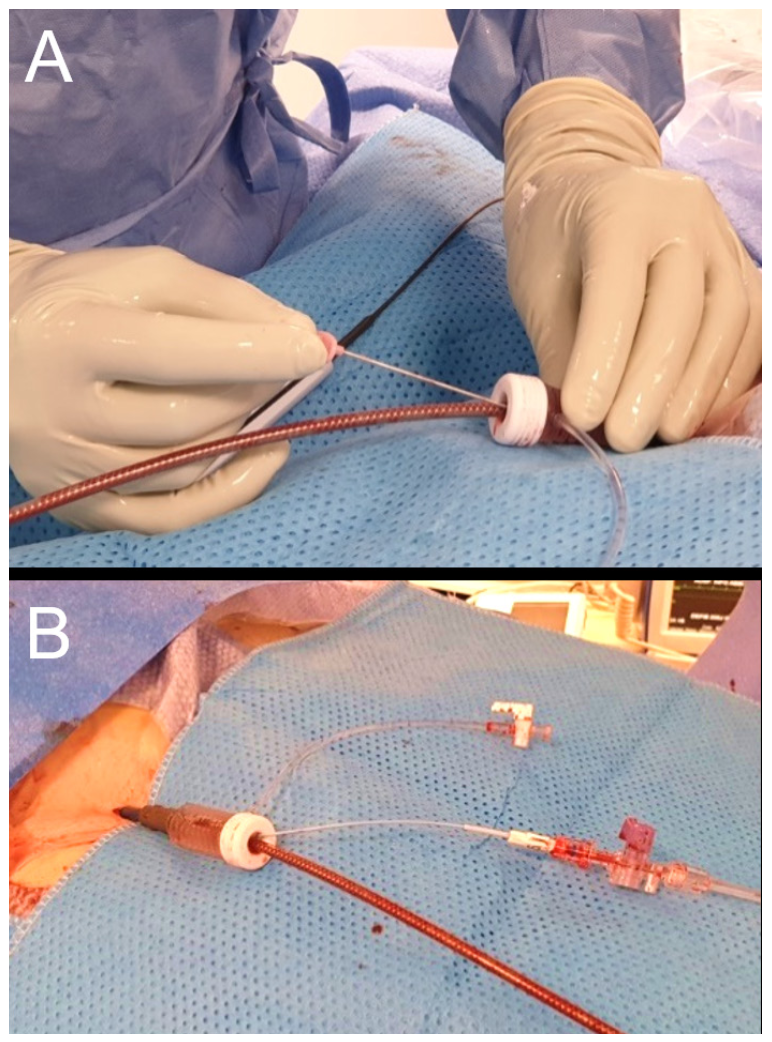 Toggweiler Femoral Access Figure 1
