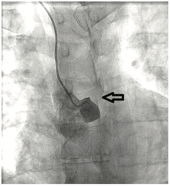 Tonks Coronary Artery Figure 1