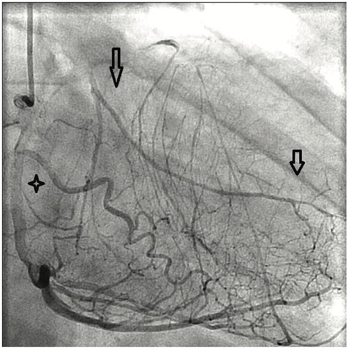 Tonks Coronary Artery Figure 2