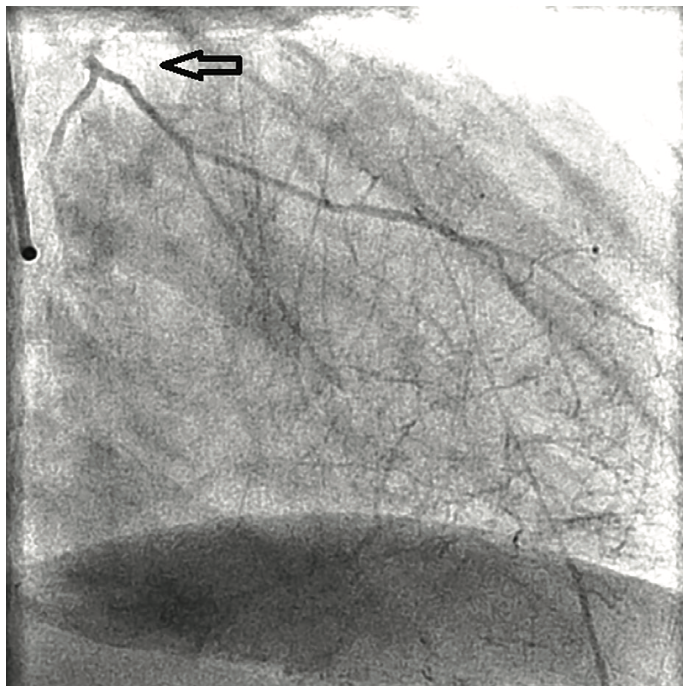 Tonks Coronary Artery Figure 3