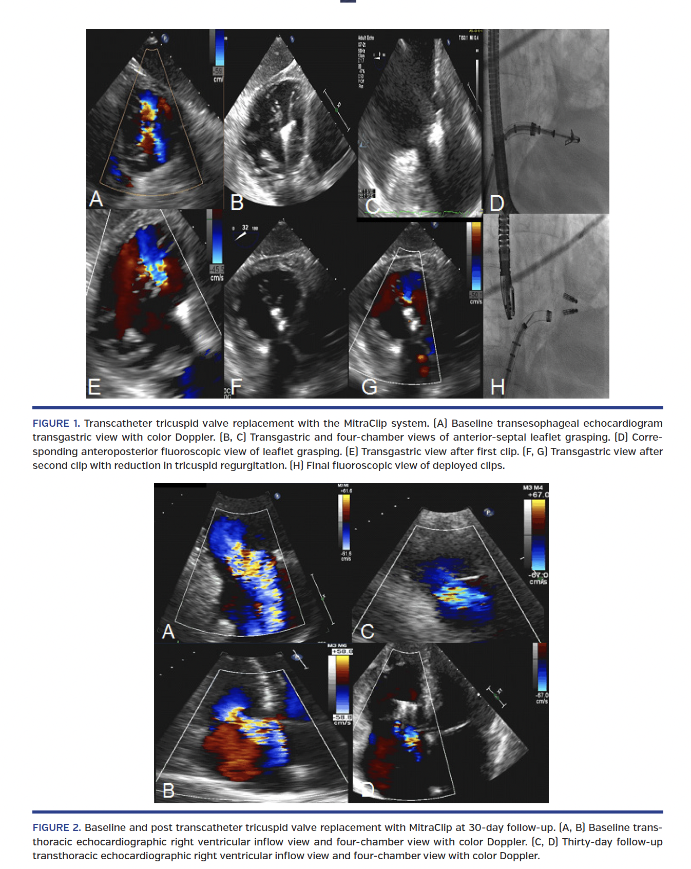 Transcatheter Tricuspid Repair With MitraClip for Severe Primary Tricuspid Regurgitation