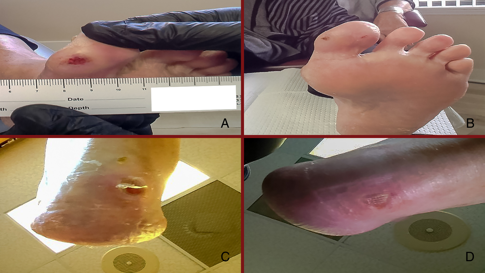 Figure 1. Photo A represents hallux ulcer initial presentation (before) and photo B reflects the hallux ulcer healed at week 4 (after). Photo C represents heel ulcer initial presentation (before) and Photo D represents the heel ulcer healed resolved at 6 weeks (after).