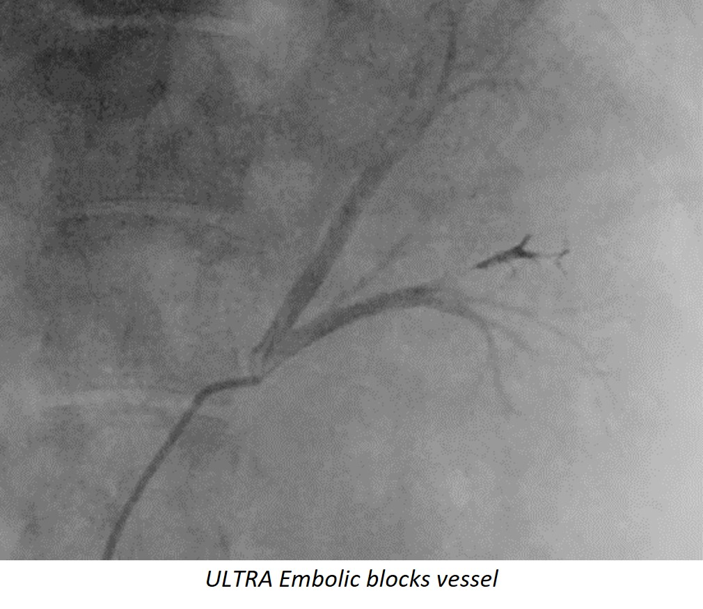 Ultra Embolic