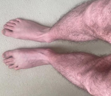 Patient standing at 2 minutes