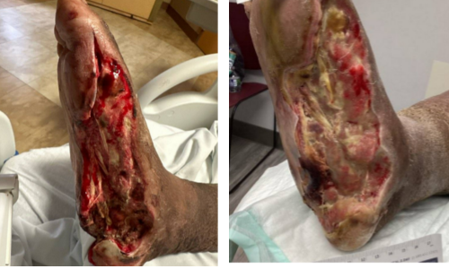 Interim photos between surgical procedures left foot. 