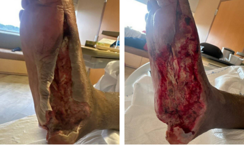 These photos show the preoperative necrosis (left) and the foot's appearance after removal of necrotic tissue (right).