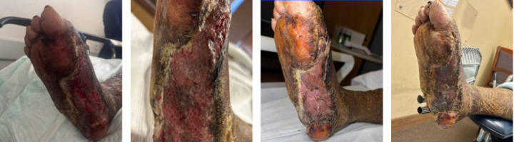 Early incorporation of the split thickness skin graft. 