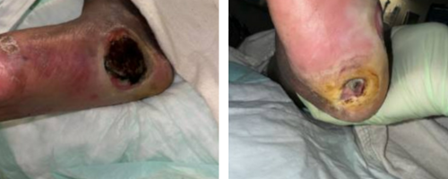 Here one can see the preoperative appearance of the left foot.