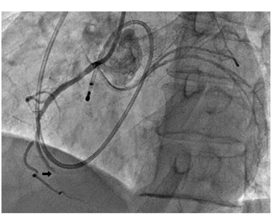 Figure 1.&nbsp;Coronary angiography; totally occluded RCA.