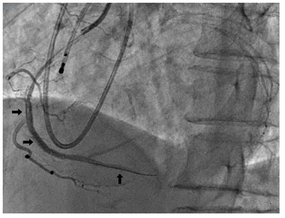 Figure 2. Both DES deployed and distal slow reflow.