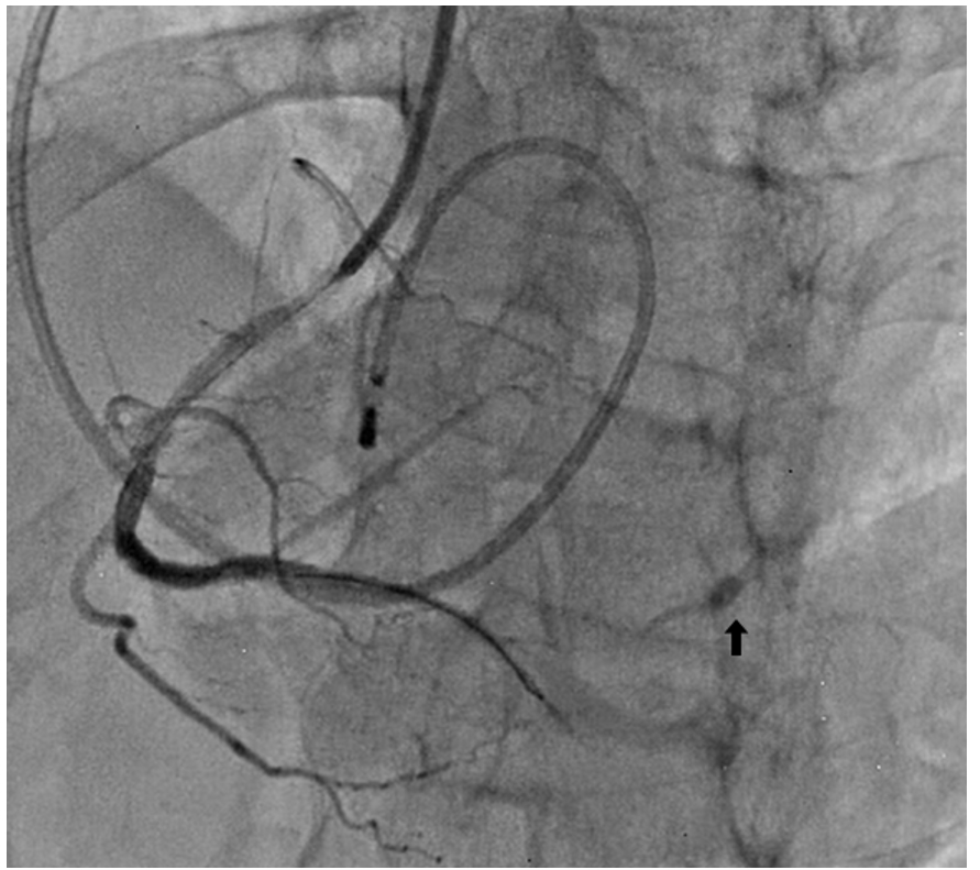 Figure 3. Post-intracoronary nitrates; side branch perforation