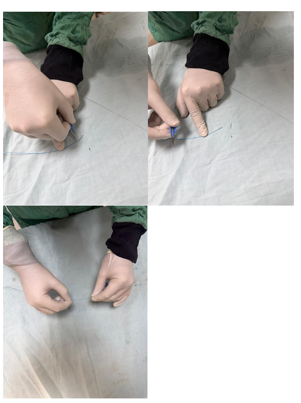 Figure 4. The cut balloon technique (CBT). (A) A 2.0 mm × 15 mm semi-compliant VexPander balloon (TT Medical, Inc.) cut transversely using a sterile surgical blade. (B) Distal balloon fragment prepared for embolization. (C) Distal balloon fragment mounted on the coronary guidewire prior to advancement to the site of perforation.