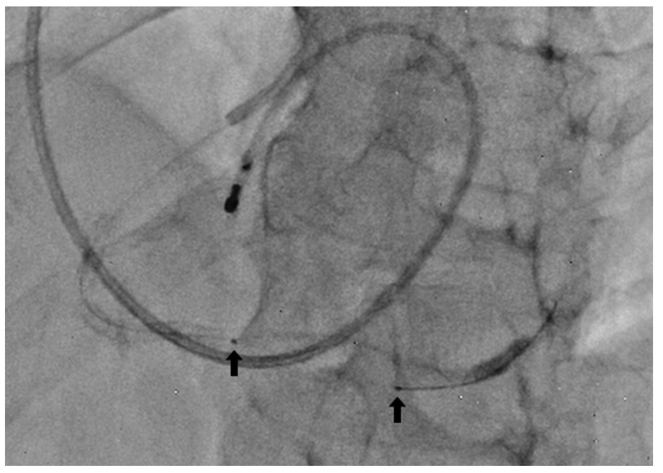 Figure 5. Balloon embolization; embolized part in the distal vessel and pusher in proximal vessel.