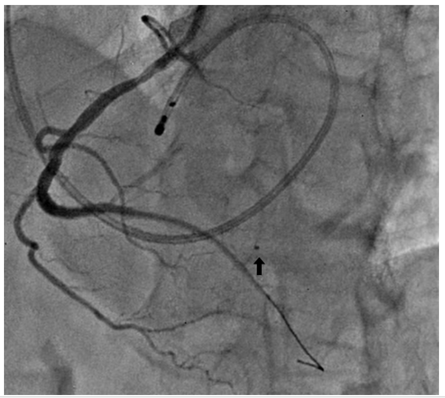 Figure 6. Final angiogram: embolized balloon and sealing of perforation.