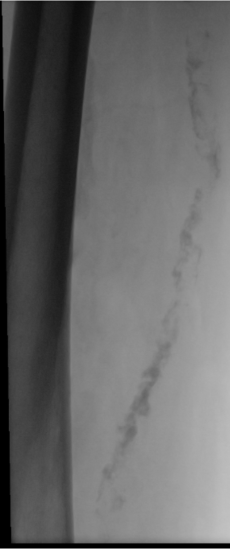 Figure A (Case #2). Severe calcified chronic total occlusion.