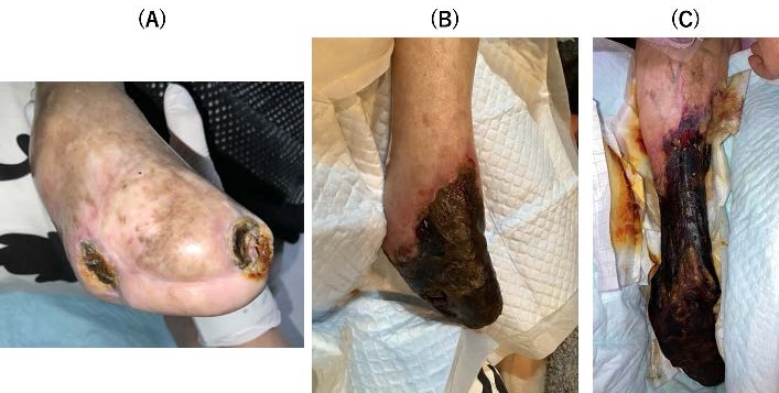 Figure 4. Clinical course of a representative patient managed with conservative wound management (CWM). (A) Baseline presentation at the initiation of CWM, showing post-minor amputation status with gangrene, exposed bone, and severe infection (92-year-old woman). (B) Appearance during the follow-up period; despite daily local care, the dry gangrene gradually expanded but the infection remained localized, and pain was well-controlled with opioids. (C) Terminal stage (approximately 12 months after CWM initiation); the patient developed extensive wet gangrene and advancing cellulitis, leading to death at home.