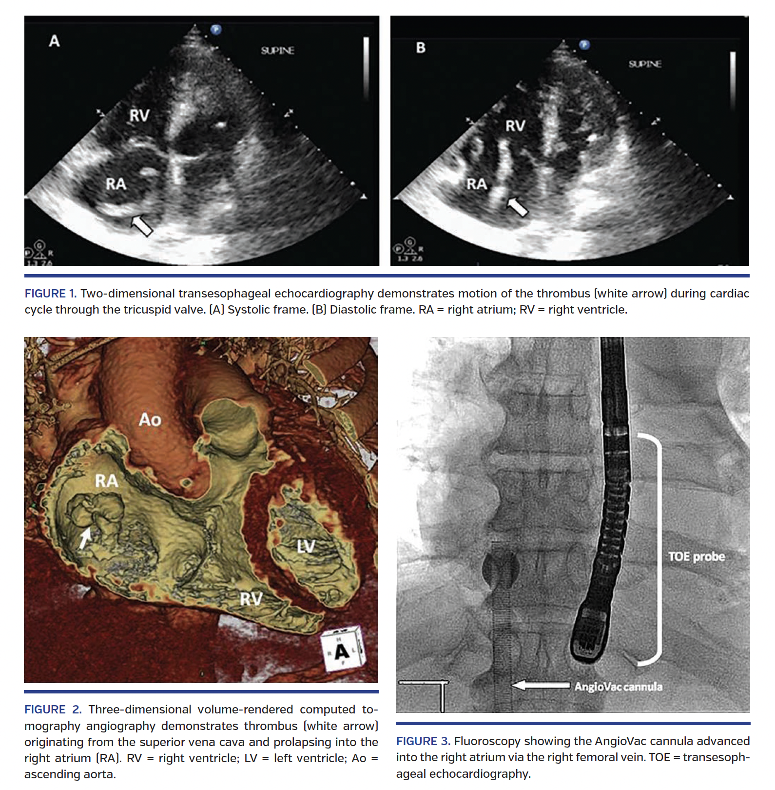 Vacuum-Assisted Thrombectomy.png