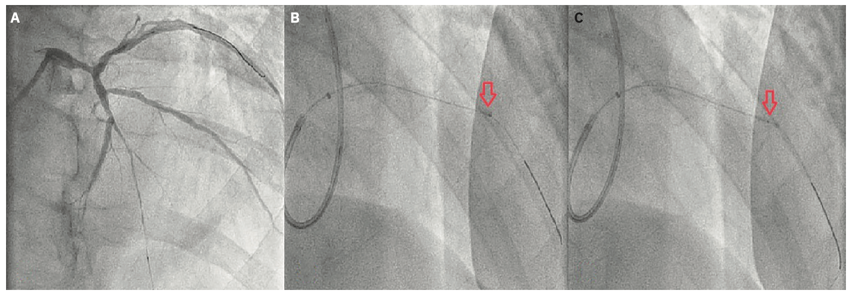 Varga Calcified Coronary Lesions Figure 2