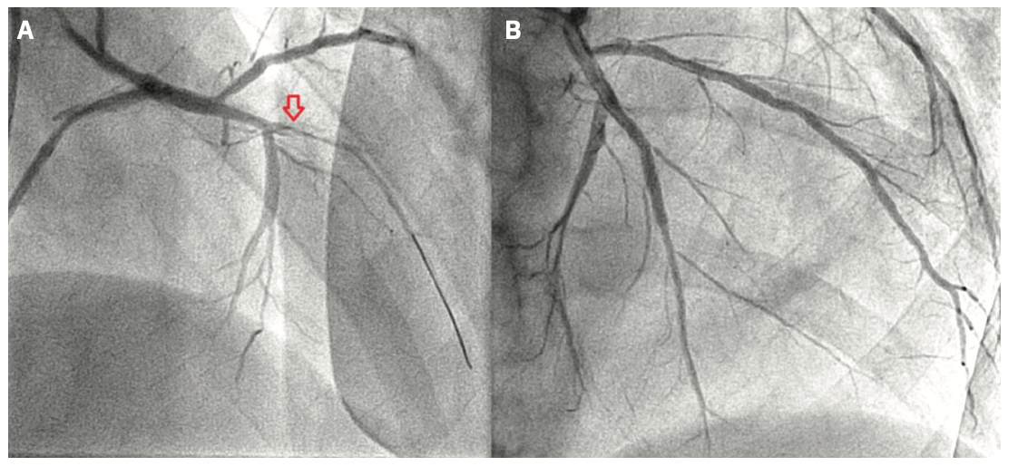 Varga Calcified Coronary Lesions Figure 3