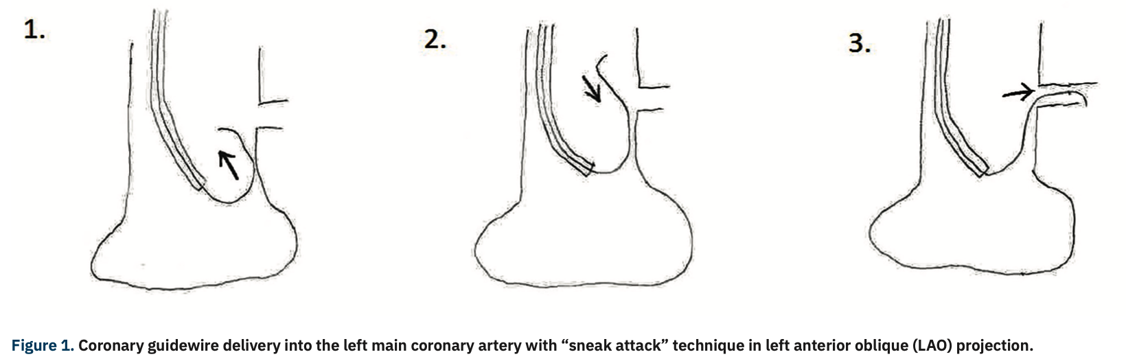 Varga Guide Extension Figure 1