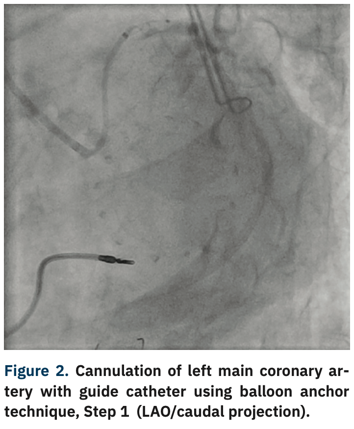 Varga Guide Extension Figure 2