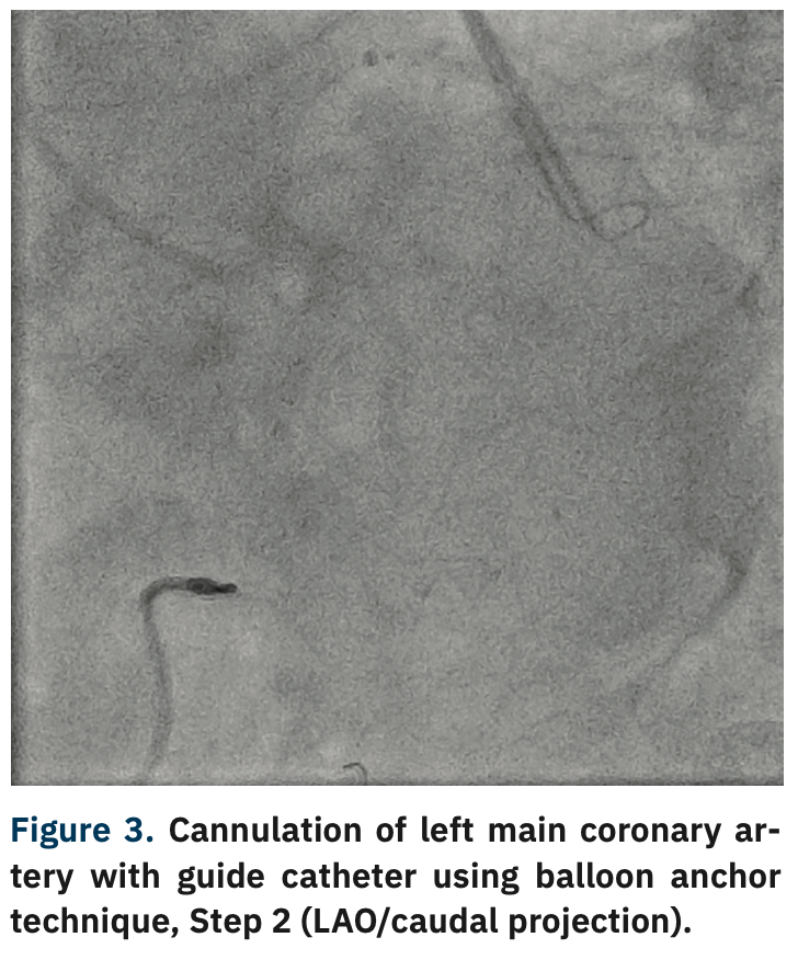 Varga Guide Extension Figure 3