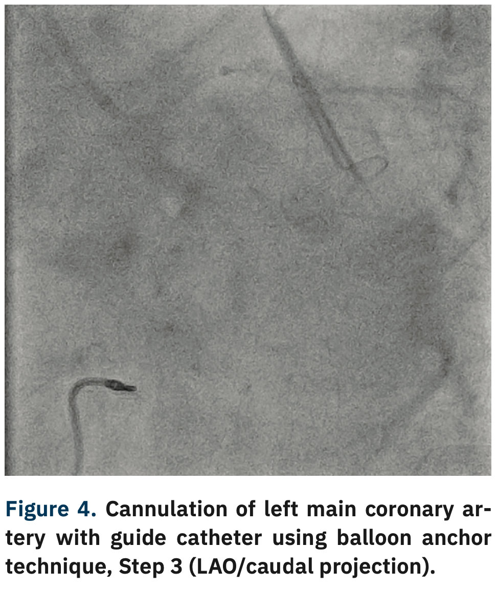 Varga Guide Extension Figure 4