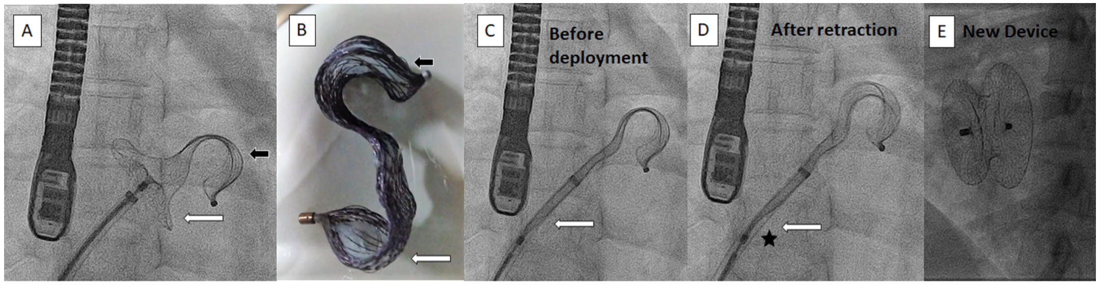 Veeraraghavan Atrial Septal Occluder Figure 1