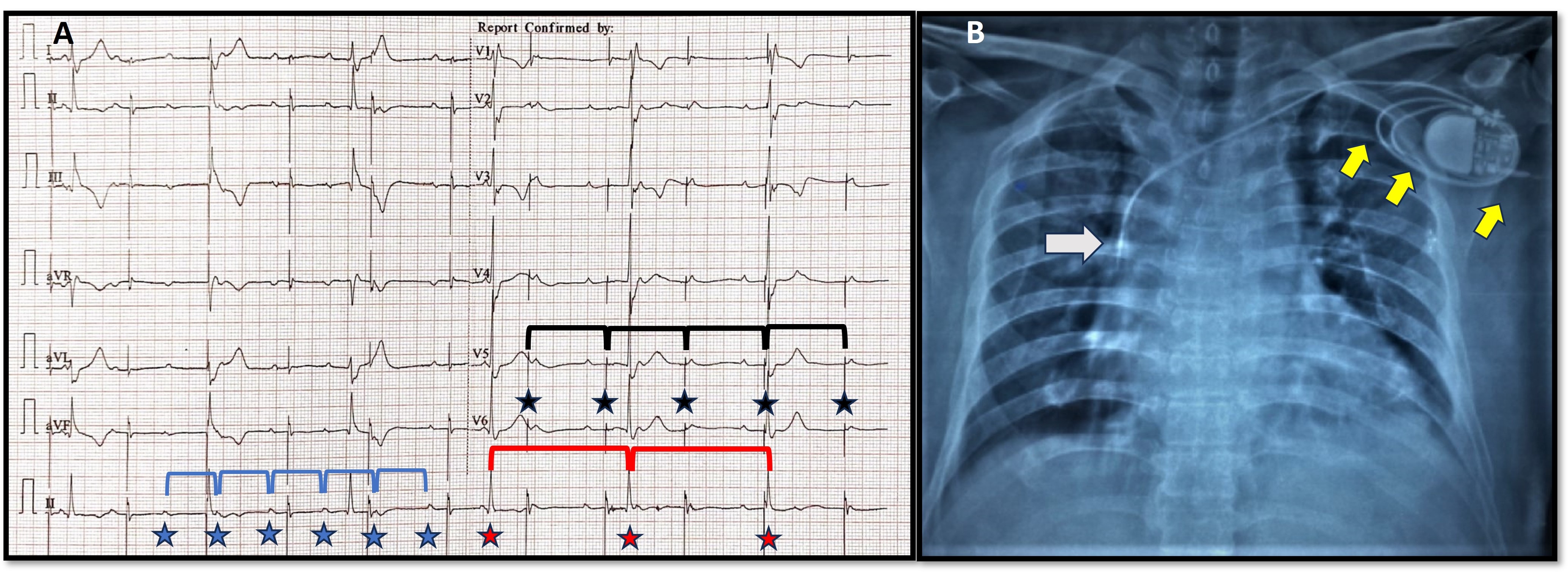 Figure 2. ECG analysis 