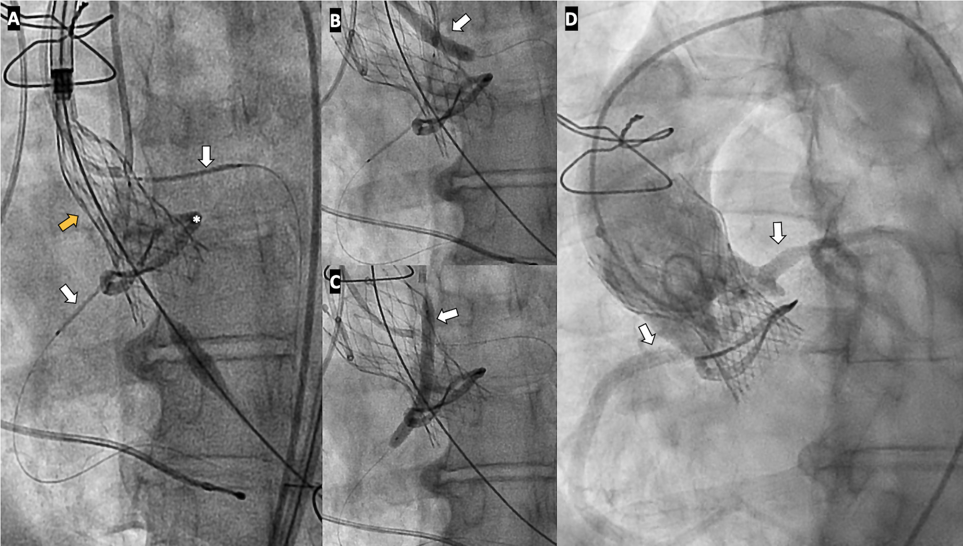 Figure 1. Chimney stenting during transcatheter valve-in-valve aortic valve implantation 