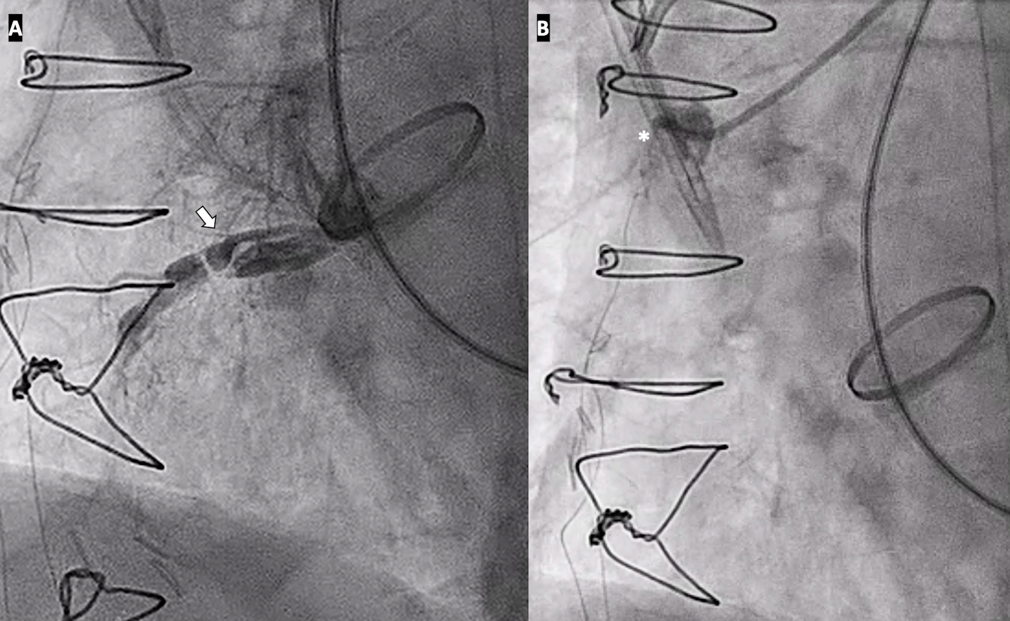 Figure 2. Coronary angiography showed right coronary artery dissection
