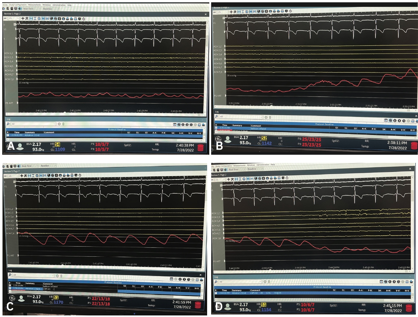 Venkataraman Cryoballoon Figure 3
